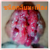 ลักษณะของโรค 3