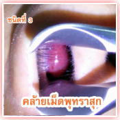 ลักษณะของโรค 3