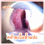 ลักษณะของโรค 4